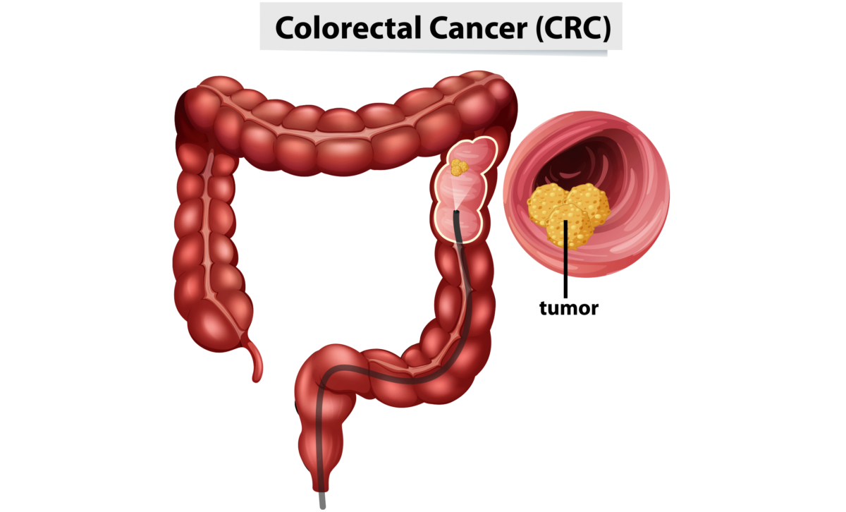 Colorectal Cancer Awareness Month Ascend Hospice Care