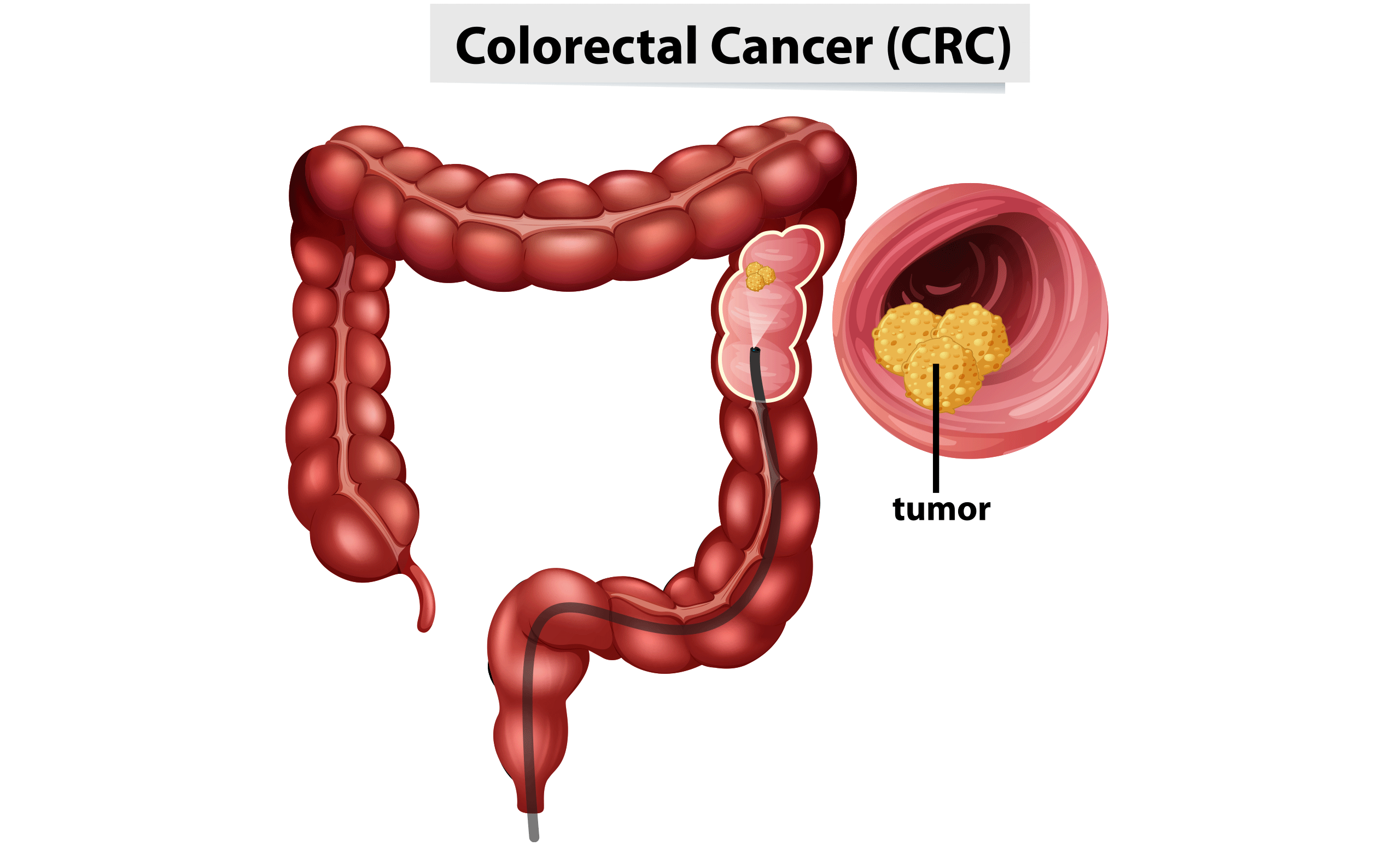 Pop-Up-Colorectal-Cancer Colorectal Cancer Awareness