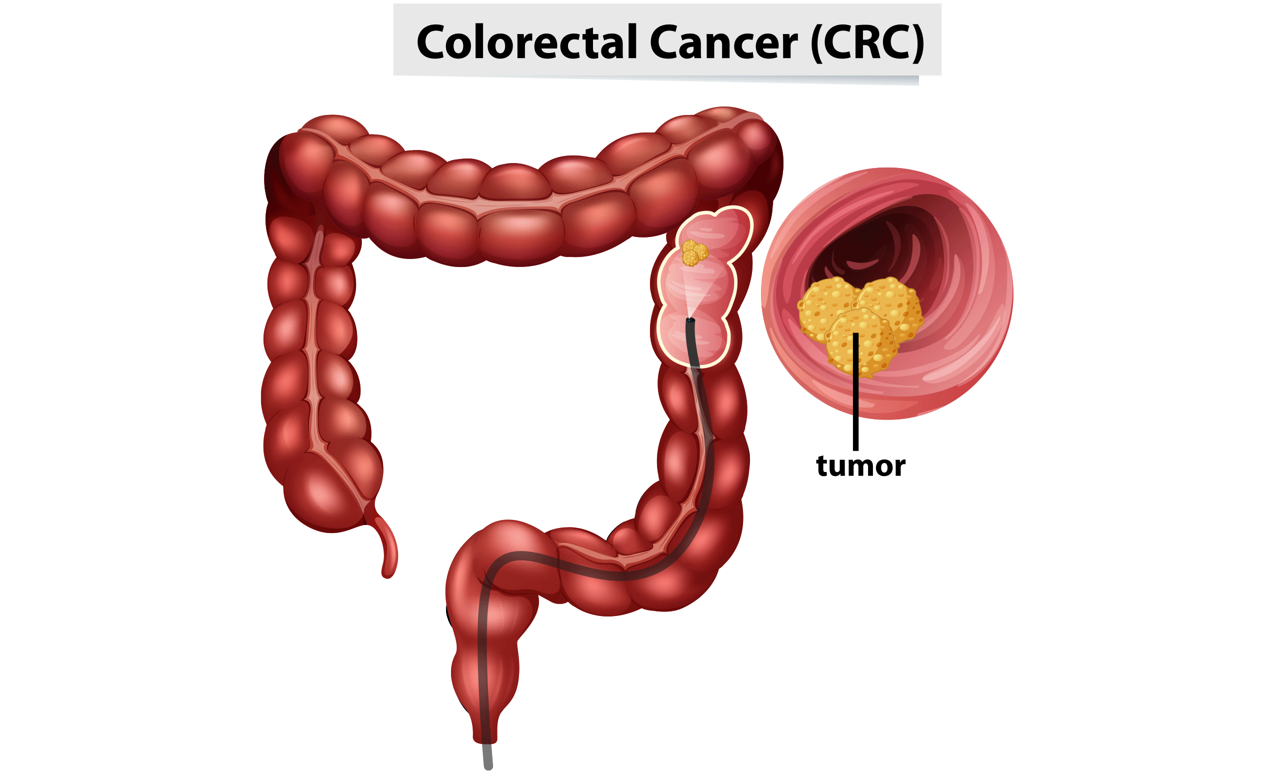 Colorectal Cancer Awareness